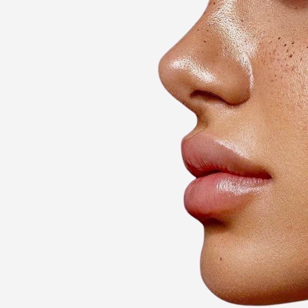 Under-Eye Filler